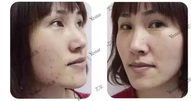 激光祛斑后还会反弹吗,激光祛斑后会不会反弹