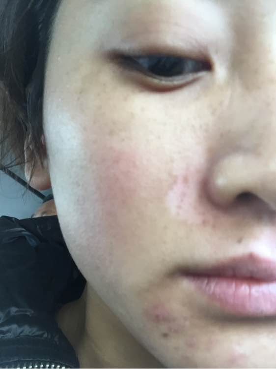 白斑光照,白斑光照后图片