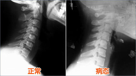 颈椎曲度变直是什么意思严重吗,颈椎生理曲度变直什么原因引起的