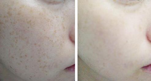 公认好用的祛斑方法,必看最好的祛斑方法