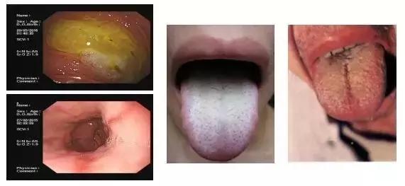 舌苔辨证图谱望舌识病,揭秘舌苔图谱轻松自诊