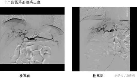 微创介入科一卫毅楠,什么是心血管介入治疗
