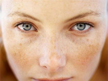 茄子擦脸真的能祛斑吗,茄子褐斑最佳治疗方法