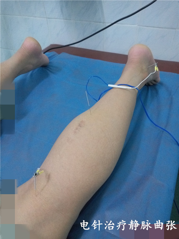 蚯蚓腿静脉曲张外用药,蚯蚓脚治疗静脉曲张