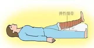 蚯蚓腿静脉曲张外用药,蚯蚓脚治疗静脉曲张