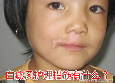 白癜风反反复复,难道真的治不好吗?