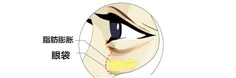 通过手术去眼袋有什么后遗症,内去眼袋手术有什么并发症