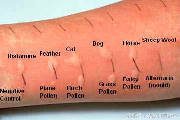反复过敏要警惕,反复过敏但测过敏源不过敏