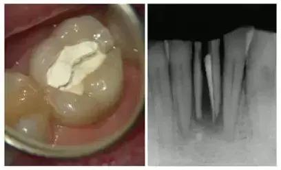 厉害了！她用缝衣针来治疗牙疼