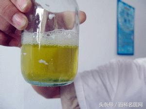 糖尿病尿里有糖有泡严重吗,尿里有糖可以确定是糖尿病吗