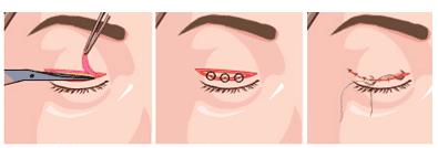 韩式三点定位双眼皮需要忌嘴么,三点定位双眼皮为啥叫韩式双眼皮