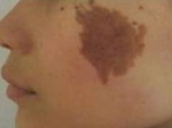 咖啡斑会让人变笨吗,咖啡斑影响颜值吗