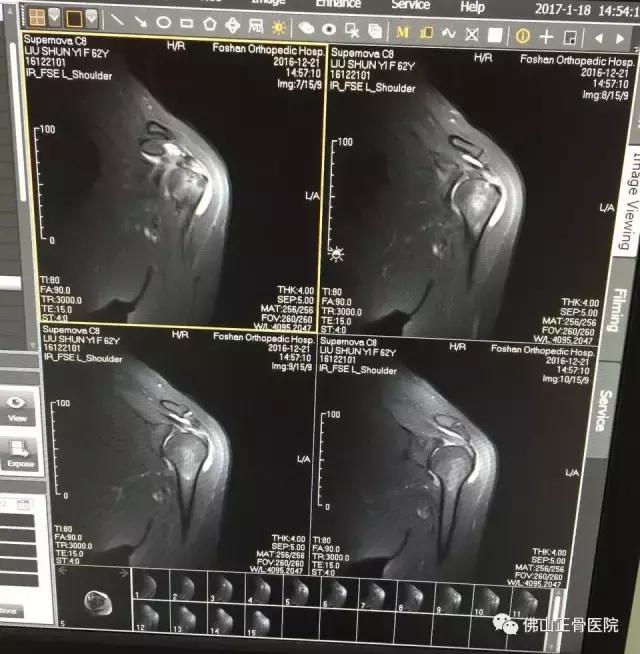 肌骨康复治疗技术讲解视频,康复学堂肩袖损伤康复训练