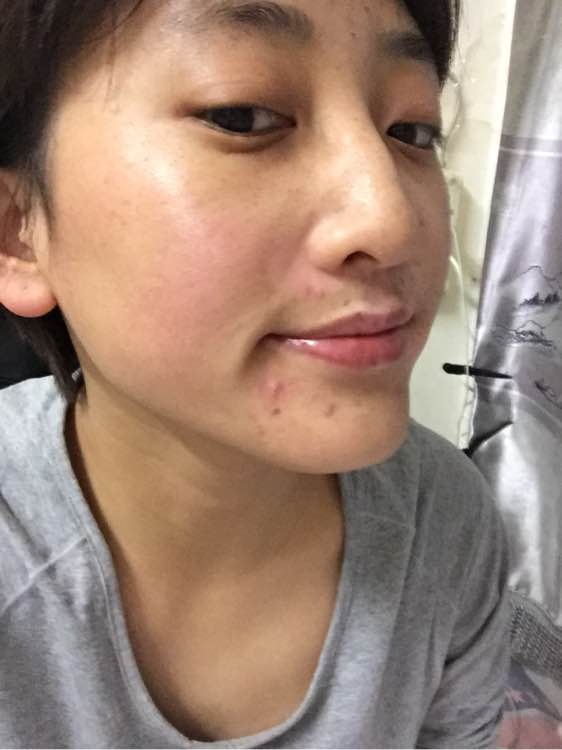 白斑光照,白斑光照后图片