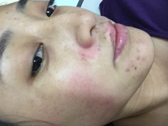 白斑光照,白斑光照后图片