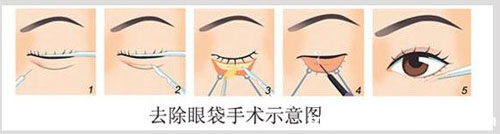 通过手术去眼袋有什么后遗症,内去眼袋手术有什么并发症