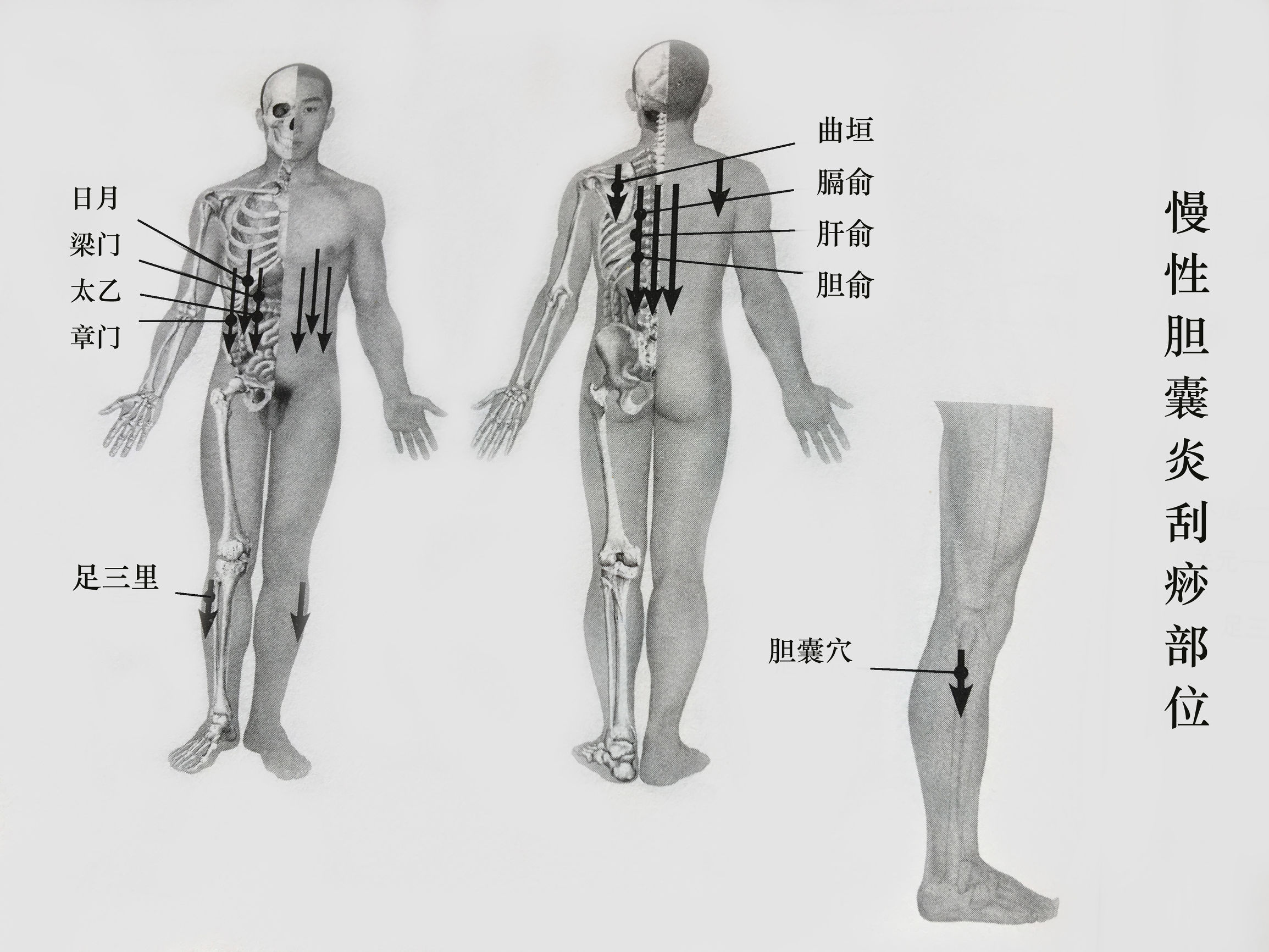 胆囊炎胆结石可以吃什么药,胆囊炎伴胆结石最佳处理方案