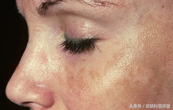 褐青色斑平时要注意什么,长褐斑是什么原因