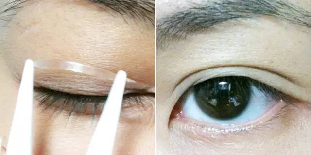 不开刀单眼皮怎么变双眼皮,内双不动刀怎么能变双眼皮