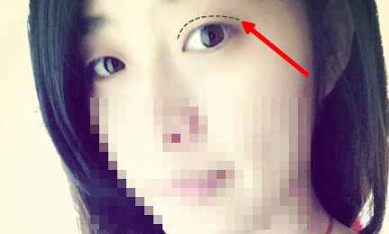 韩式三点定位双眼皮需要忌嘴么,三点定位双眼皮为啥叫韩式双眼皮