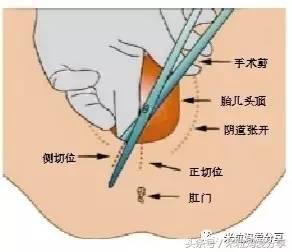 angelababy是顺产还是剖腹产的,angelababy是顺产还是剖腹产