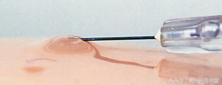 反复过敏要警惕,反复过敏但测过敏源不过敏