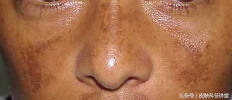 褐青色斑平时要注意什么,长褐斑是什么原因