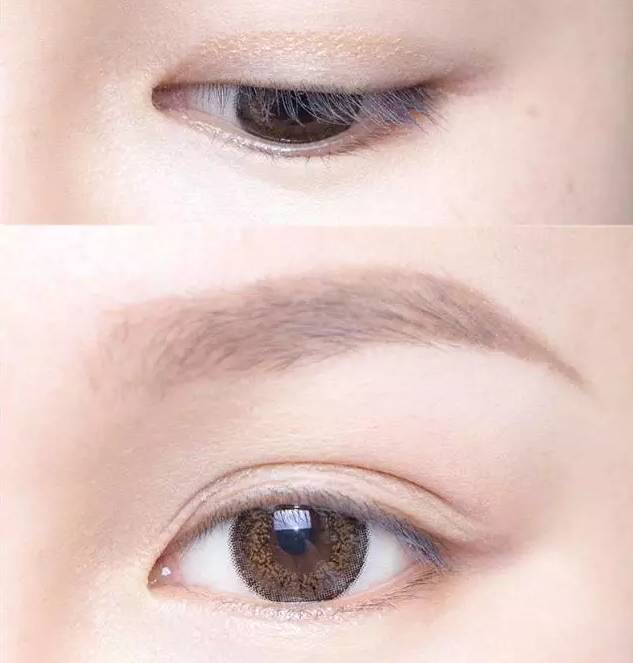不开刀单眼皮怎么变双眼皮,内双不动刀怎么能变双眼皮