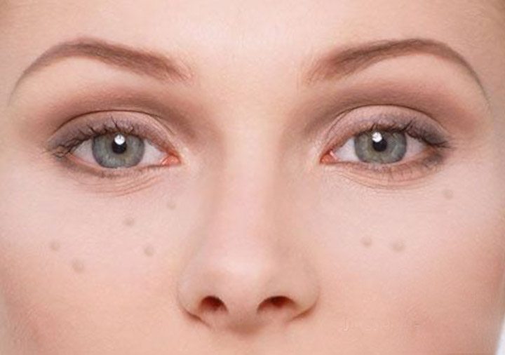 脸上最近一直长脂肪粒怎么办,脸上反反复复长脂肪粒怎么消除