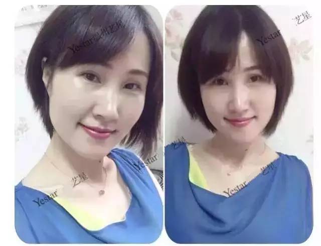 激光祛斑后还会反弹吗,激光祛斑后会不会反弹