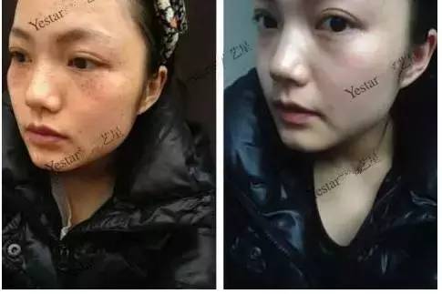 激光祛斑后还会反弹吗,激光祛斑后会不会反弹