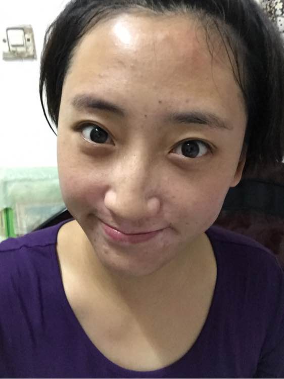 白斑光照,白斑光照后图片