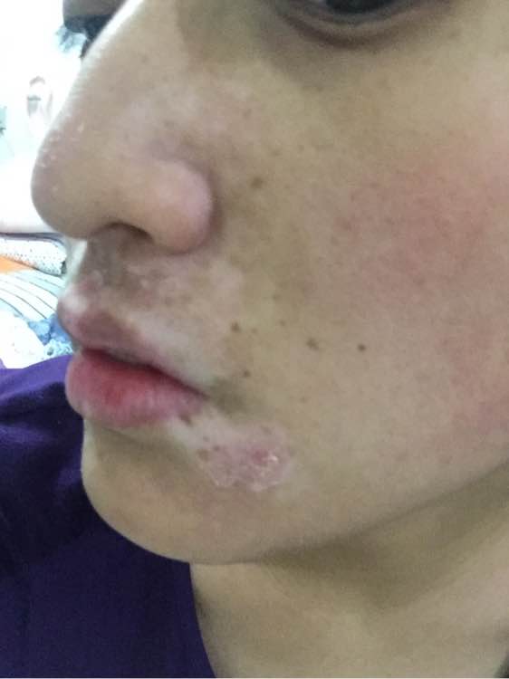 白斑光照,白斑光照后图片