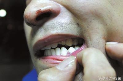 过年牙齿掉了一块,过年牙齿掉好不好