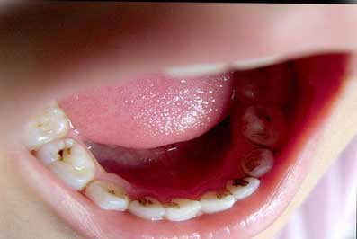 为什么牙齿缝隙发黑,牙齿发黑去除小窍门