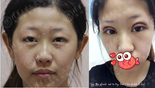 割双眼皮轻微痛感正常吗,割双眼皮很痛吗