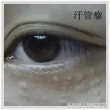 怎么区分汗管瘤脂肪粒还是粟丘疹,眼周的脂肪粒不去除