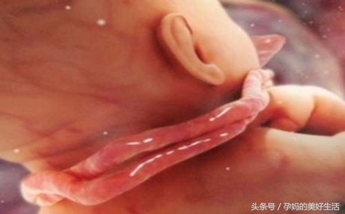 脐带绕颈3周纠正过来的成功案例,脐带绕颈一周可以做胎位纠正操吗