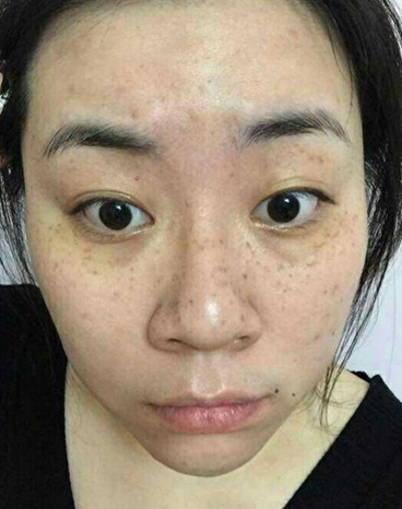 祛斑小方法及用法,巧用白醋帮你有效祛斑