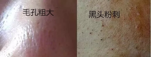 还在为毛孔粗大黑头粉刺而烦恼吗,还在为鼻炎烦恼吗