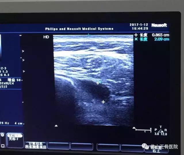 肌骨康复治疗技术讲解视频,康复学堂肩袖损伤康复训练