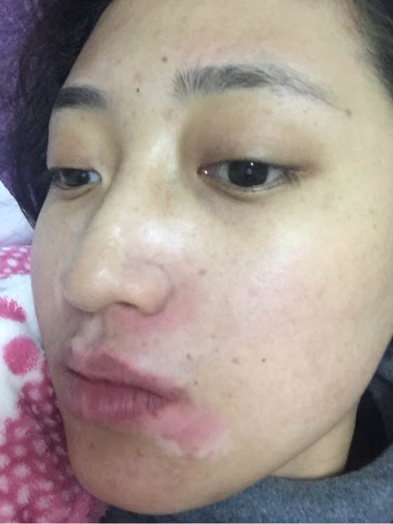 白斑光照,白斑光照后图片