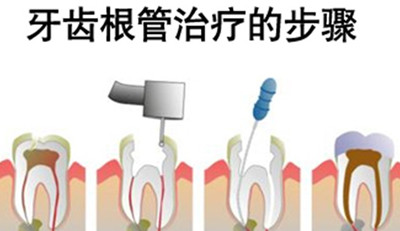 牙齿根管治疗1200跟900有什么区别,所有牙都适合做根管治疗吗