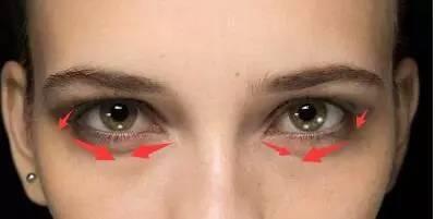 消除黑眼圈和眼袋的最有效的方法,最严重的黑眼圈