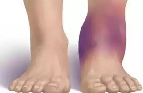 冻天运动扭伤脚踝正确处理方法,冬天运动脚踝扭伤怎么办
