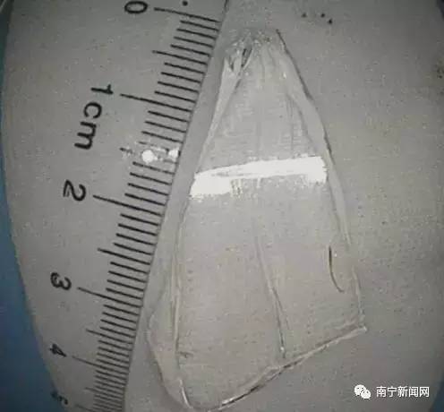 惊呆｜南宁一女孩怒吞玻璃，竟然是因为……