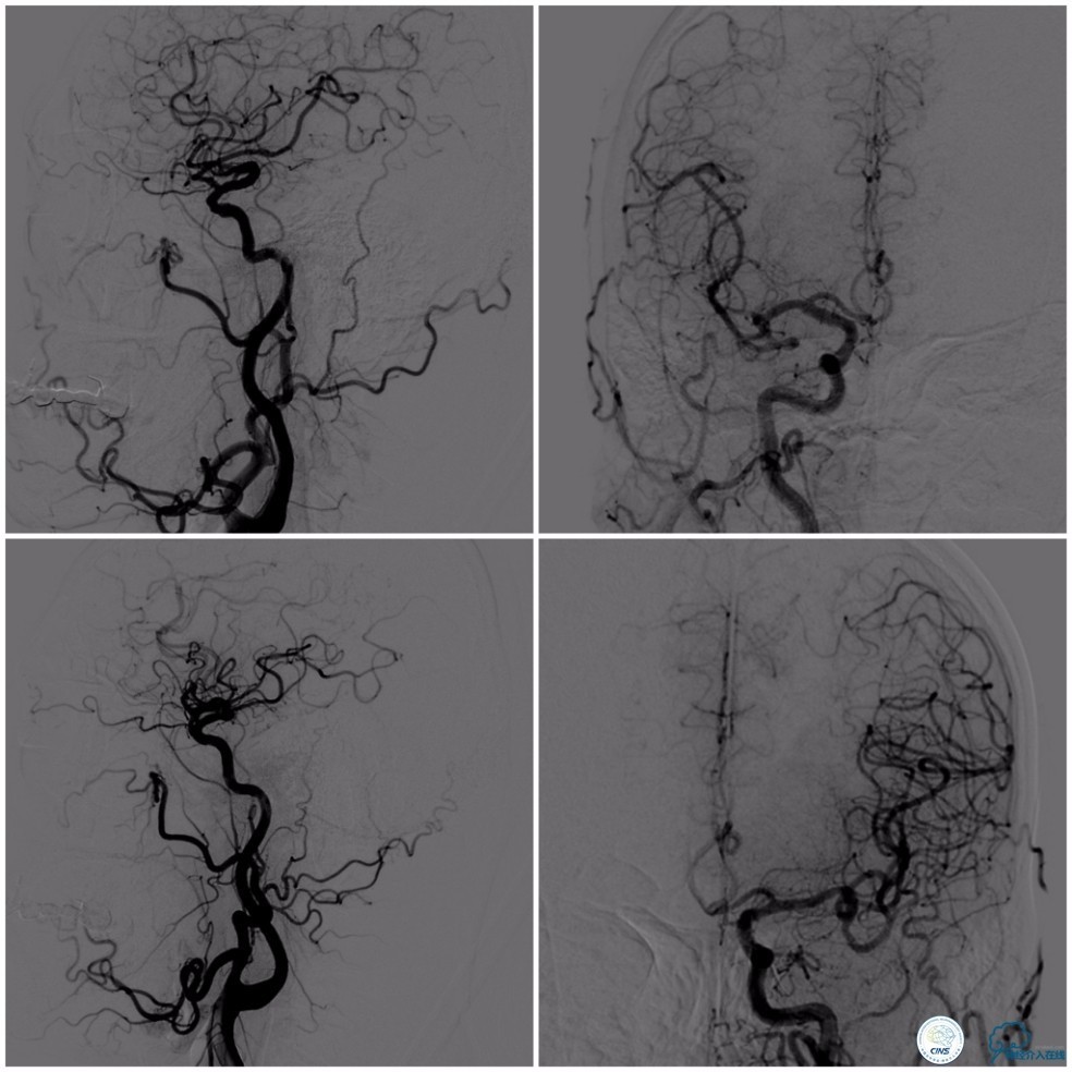 天坛周记｜基底动脉狭窄合并动脉瘤血管内介入治疗一例