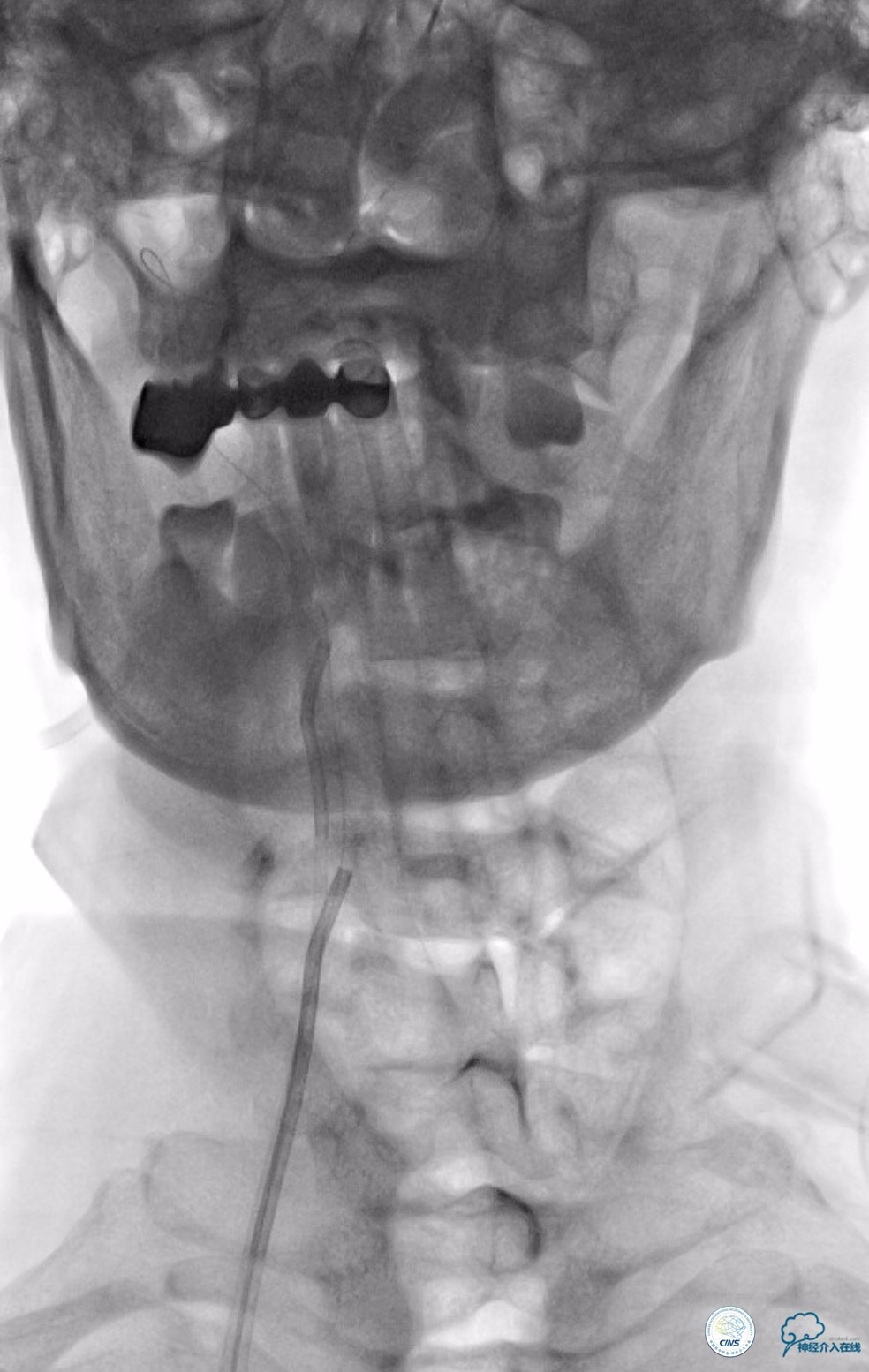 天坛周记｜基底动脉狭窄合并动脉瘤血管内介入治疗一例