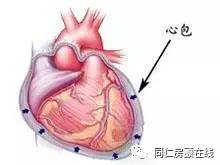 房颤射频消融术风险高吗,房颤导管射频消融手术的利弊