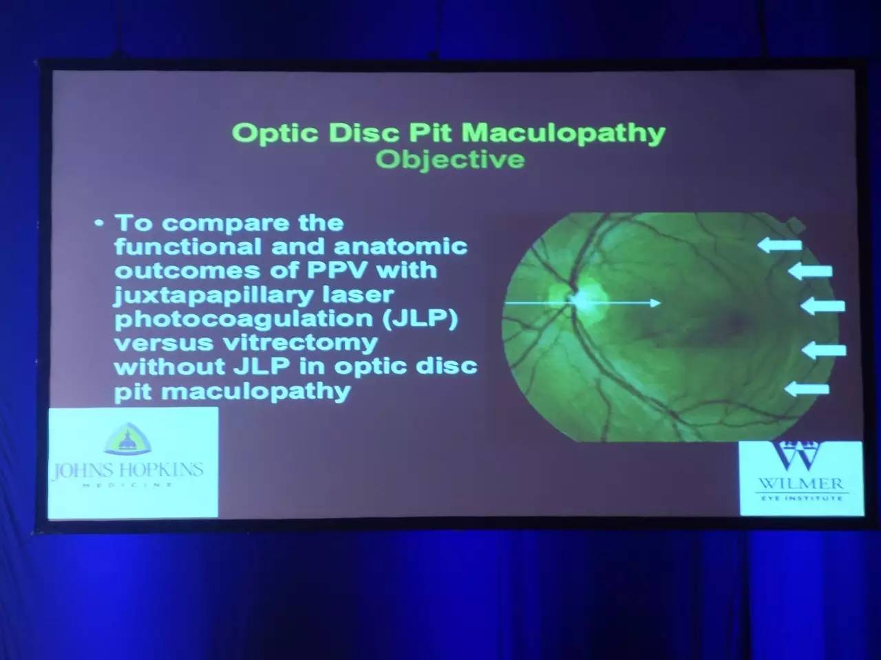 视网膜黄斑缺损能治好吗,视网膜黄斑缺损